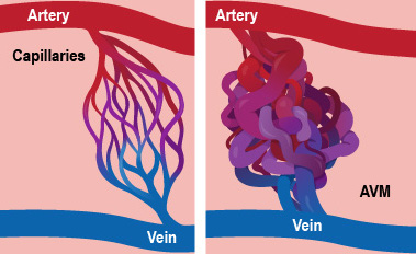 Diagram showing an artery and vein connected by capillaries and an artery and vein with an arterial venous malformation (AVM) in the connection.