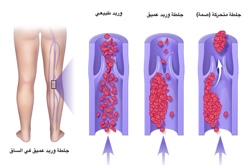 You are currently viewing علاج الجلطات الوريدية