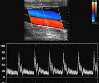 تصوير الاوعية الدموية التراساوند