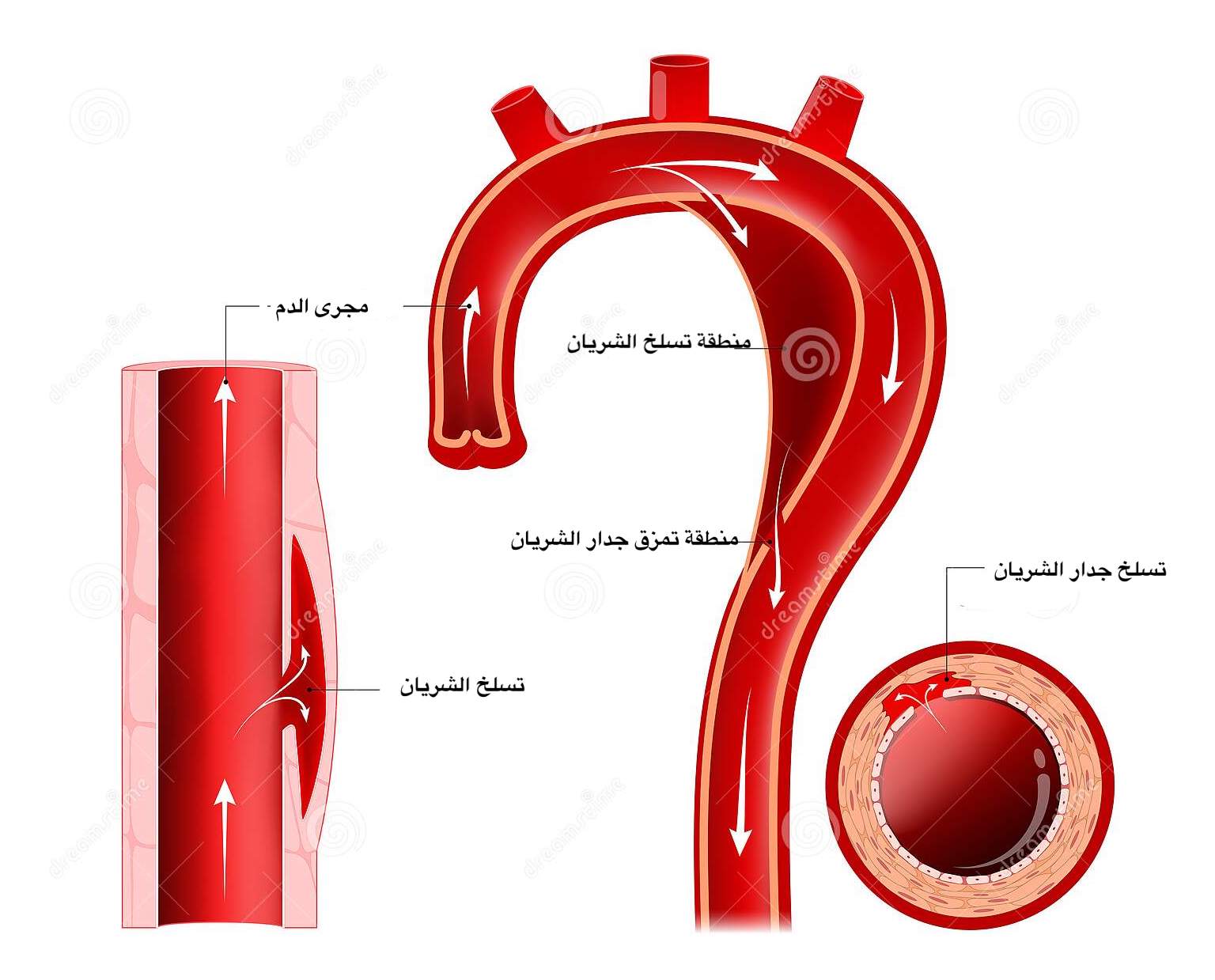 علاج تسلخ الشريان الابهر