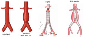 Read more about the article علاج ام الدم الأبهرية الصدرية او البطنية