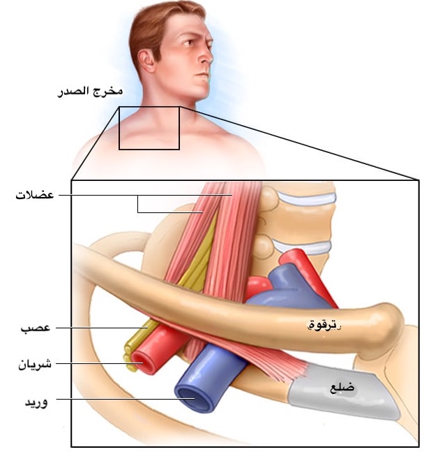 You are currently viewing معالجة متلازمة مخرج الصدر والضلع الرقبية￼